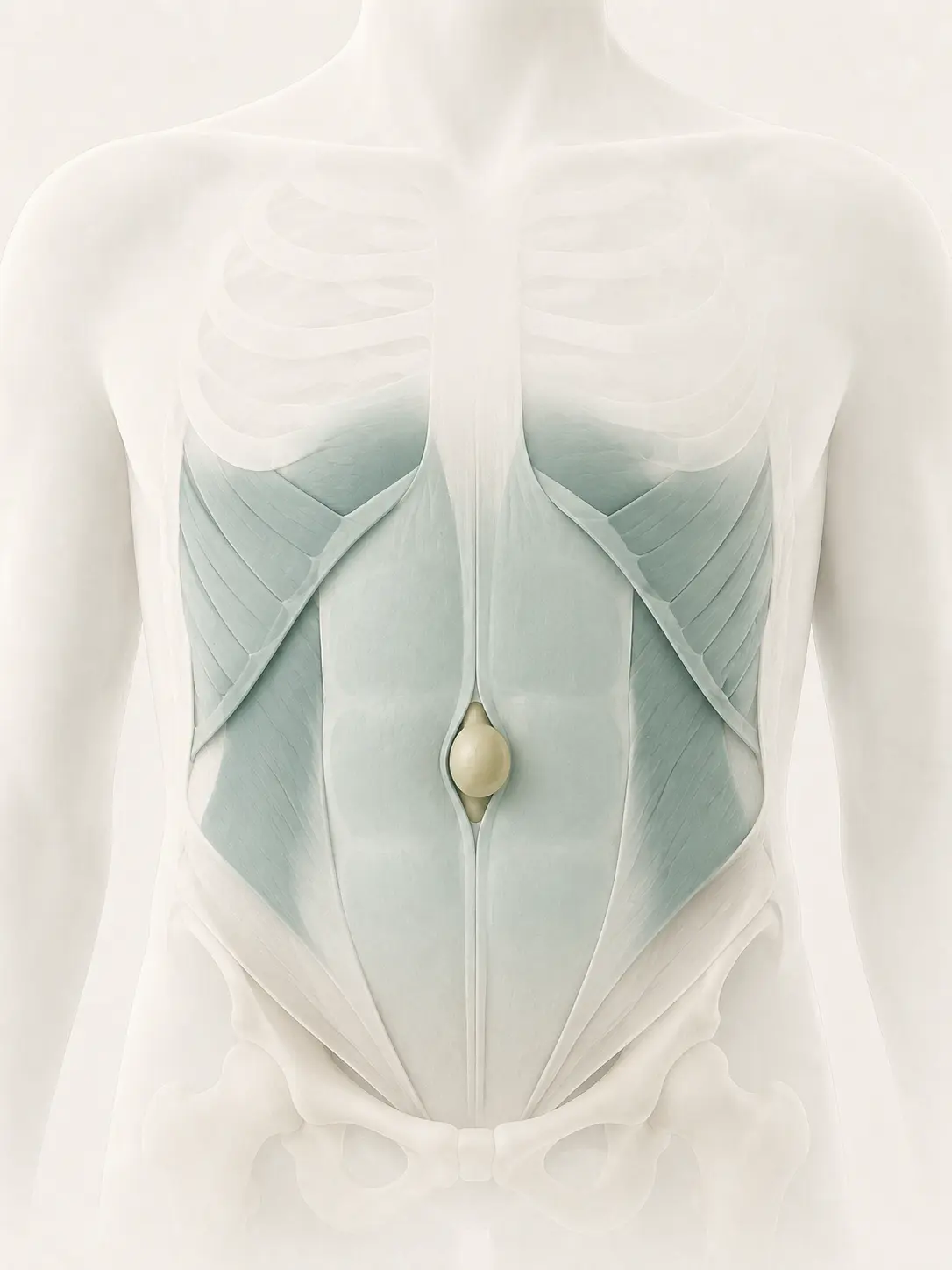 Ilustração da parede abdominal com hérnia umbilical em destaque